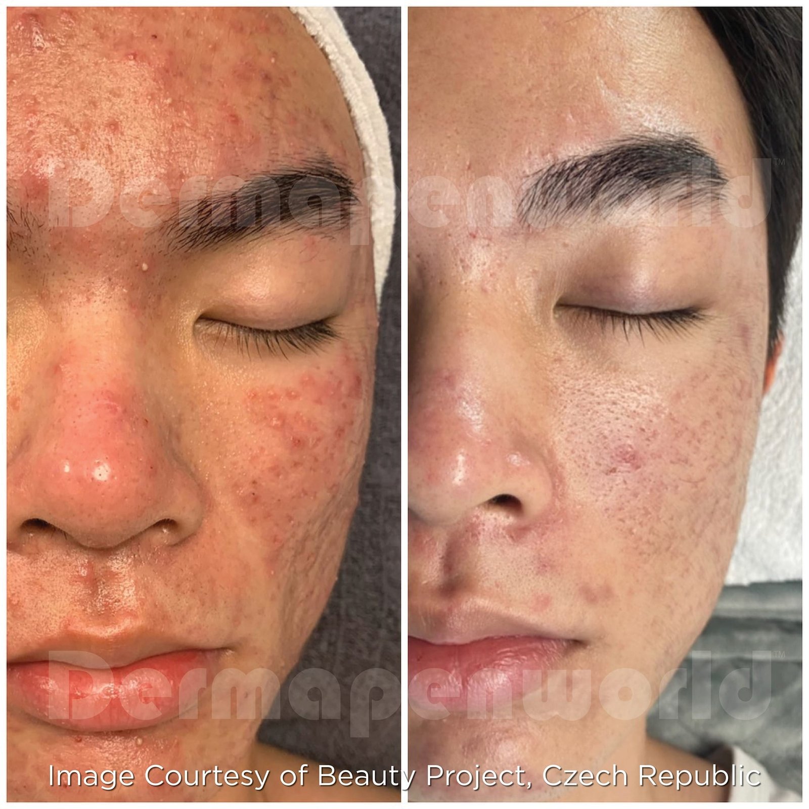 Microneedling dermapen microneedling-dermapen-male-acne