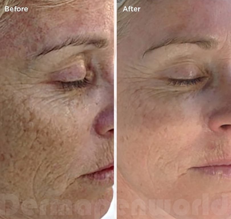 Microneedling dermapen microneedling-dermapen-before-after