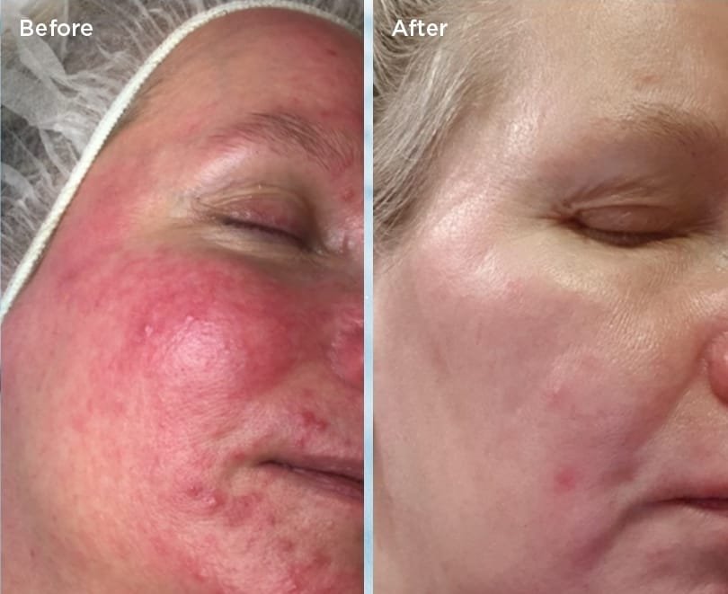 Microneedling dermapen microneedling-dermapen-rosacia