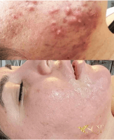 SQT ACNE