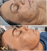 SQTpigmentation