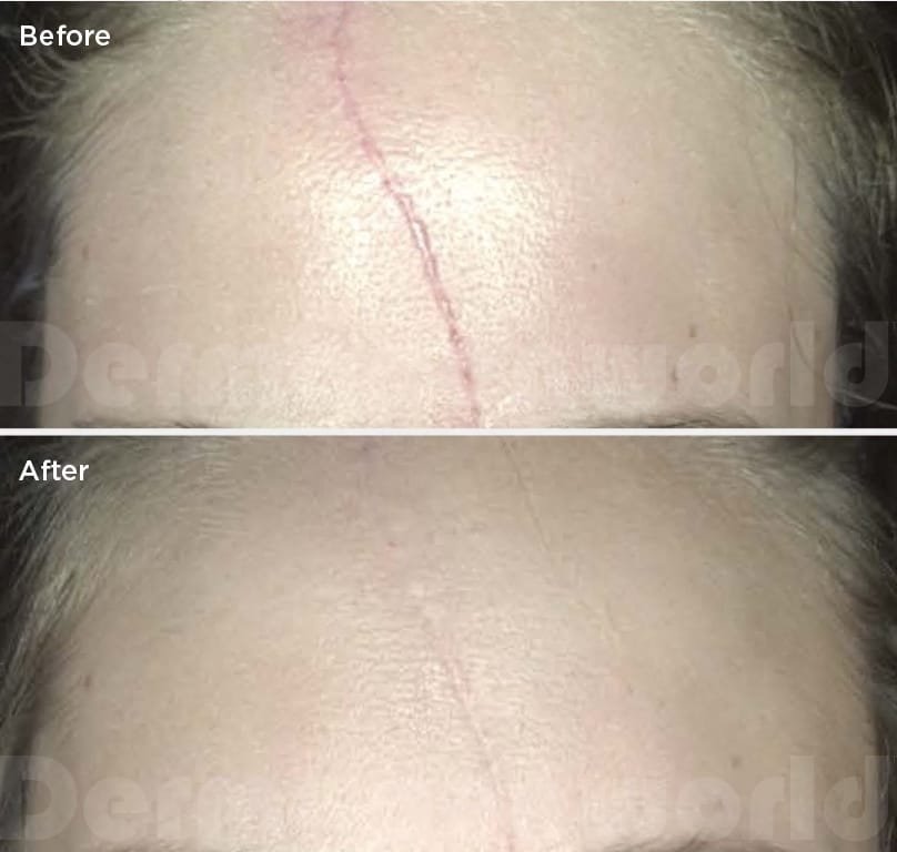 Microneedling dermapen microneedling-dermapen-scar